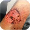 Managing Symptoms of Malignant Wounds